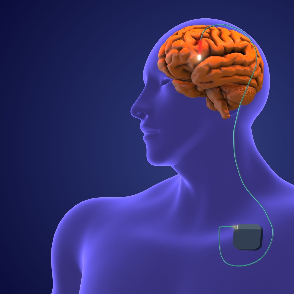 An Overview of Deep Brain Stimulation How It Works and Who Can Benefit Blog Featured Image