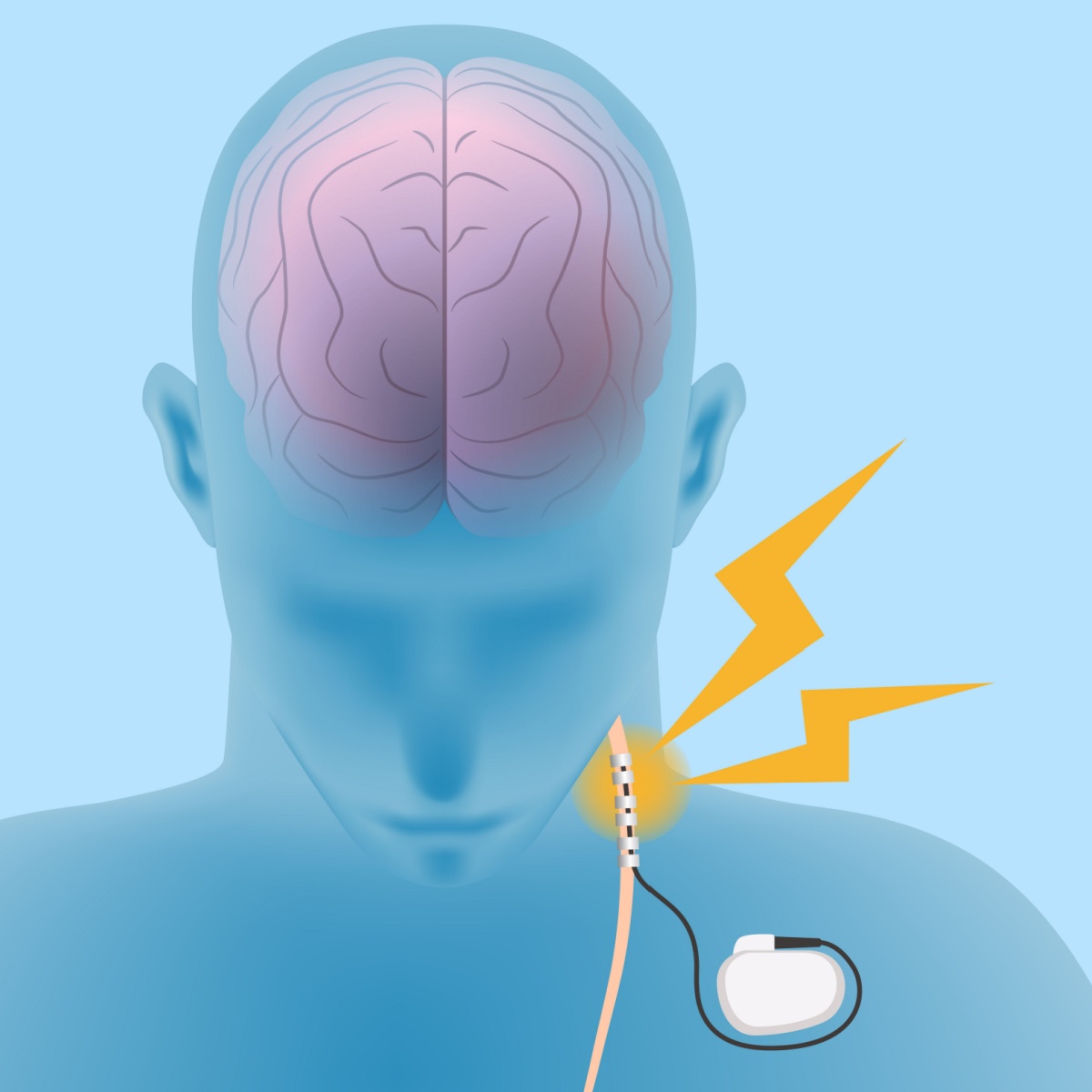 Vagus Nerve Stimulation